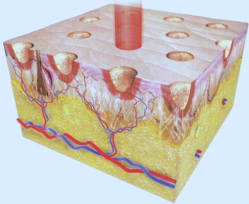 fraksiyonel lazer termoliz