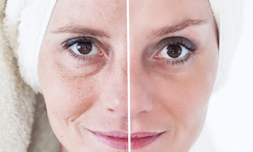 lazerle yüz gençleştirme